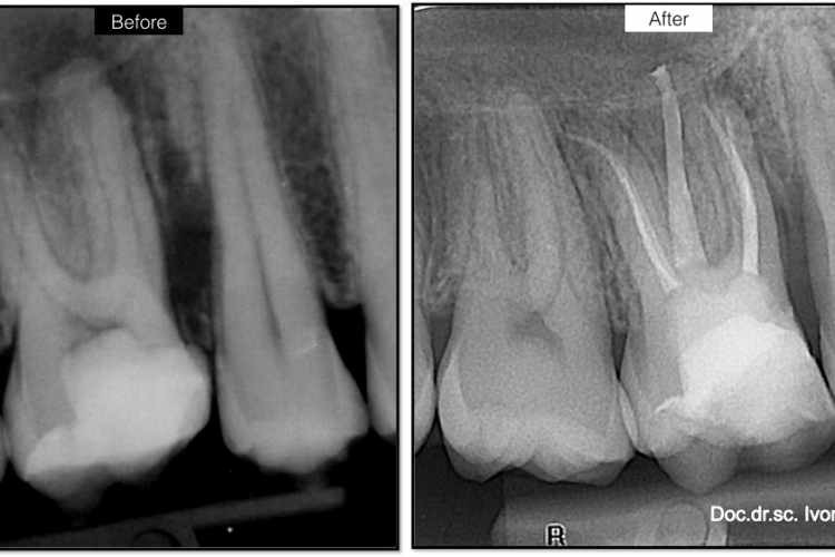 endodoncija prije i poslije