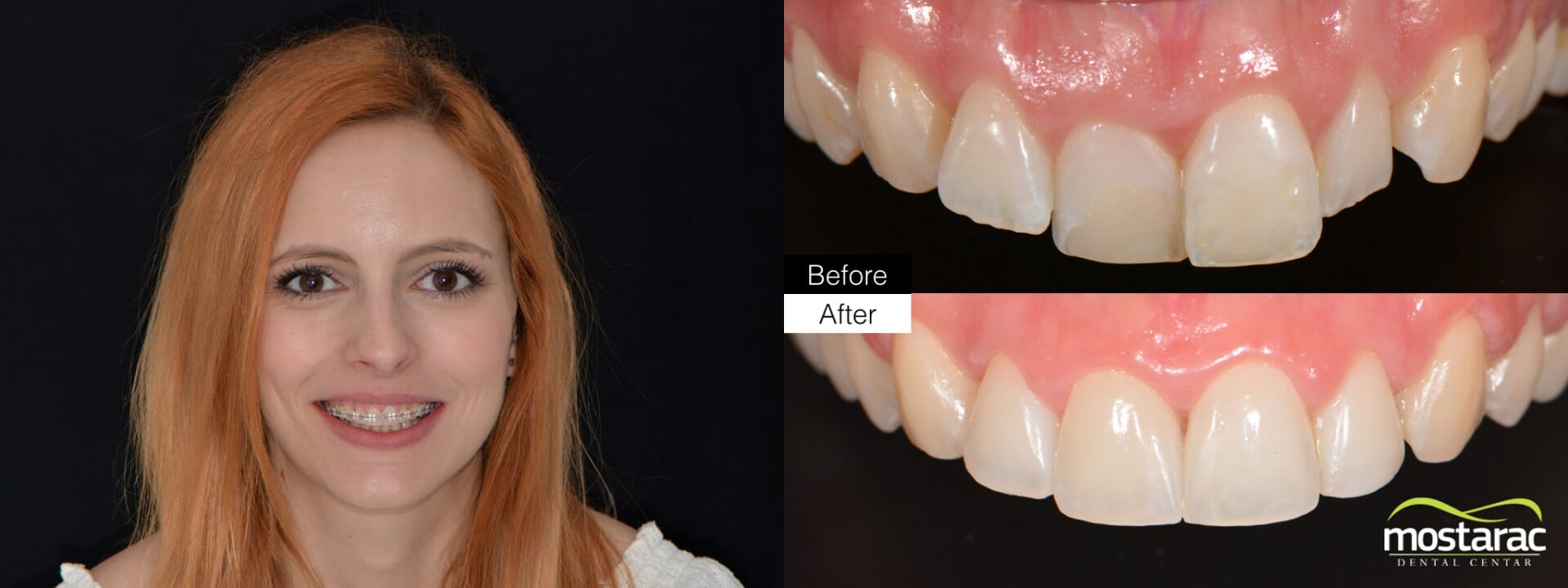 ortodoncija prije poslije