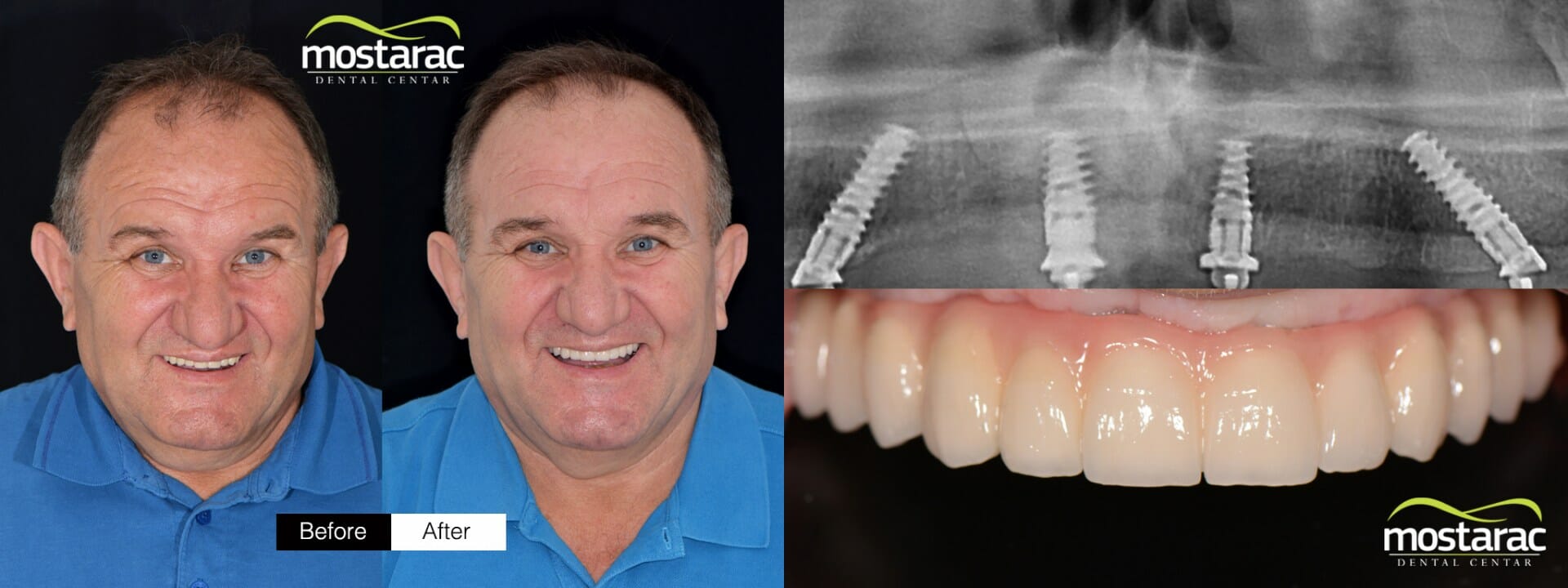 zubni implantati all on 4