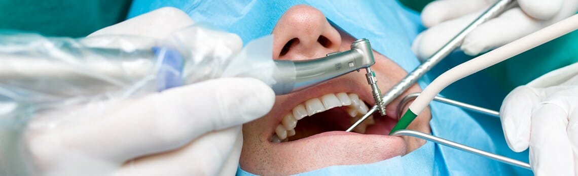 ugradnja zubnog implantata