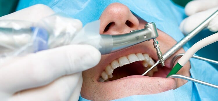 ugradnja zubnog implantata