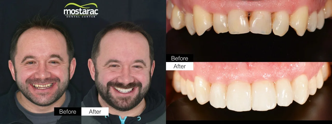 Dental-centar-Mostarac-implantati-smile-design-krunice-ljuskice-veneers-izbjeljivanje-all-on-4-implantati-ortodoncija-aparatic-4